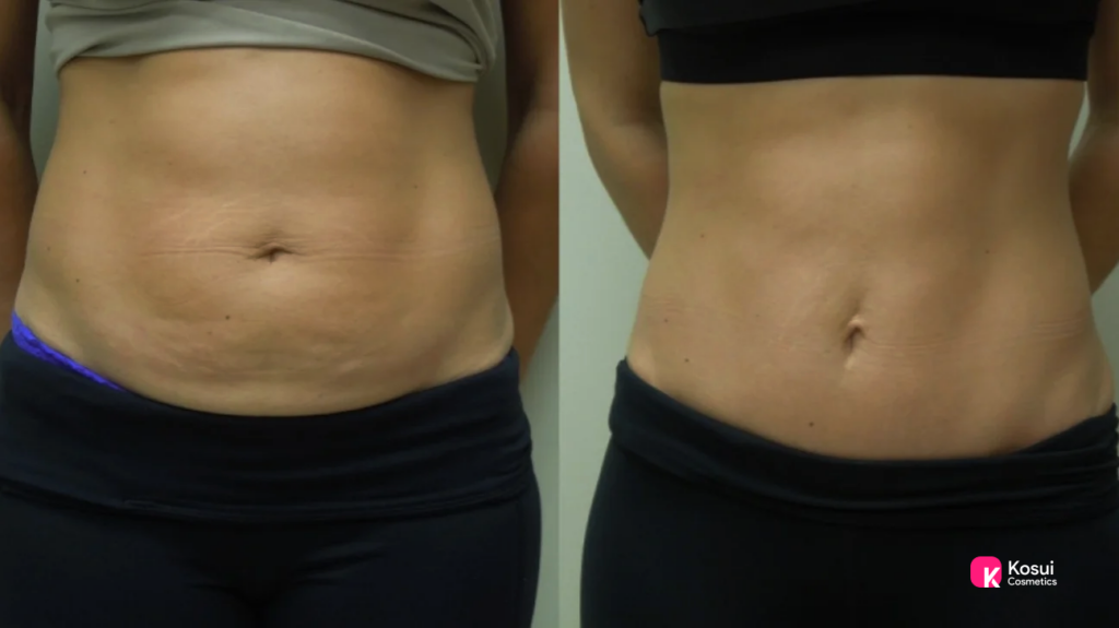 Mini Tummy Tuck Before and After