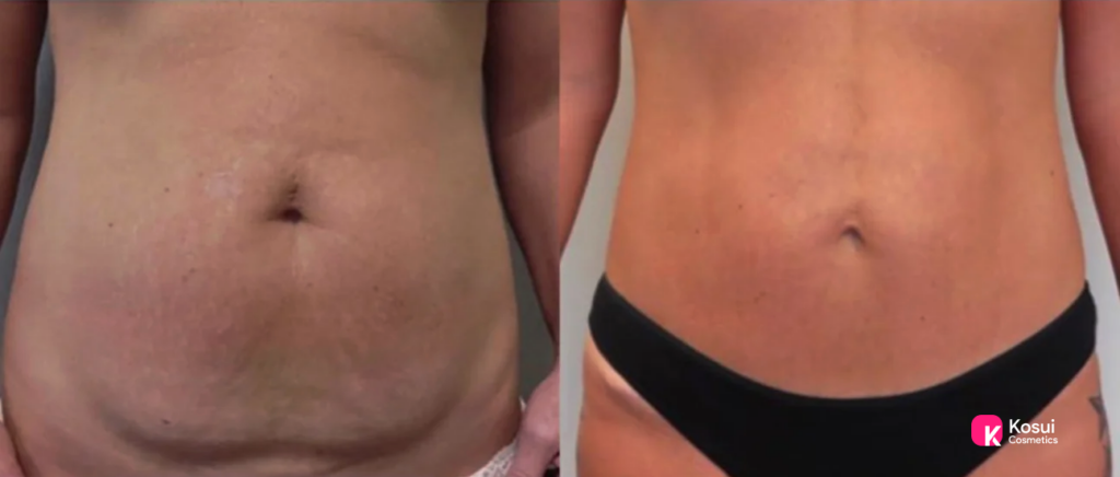 Mini Tummy Tuck Before and After 3